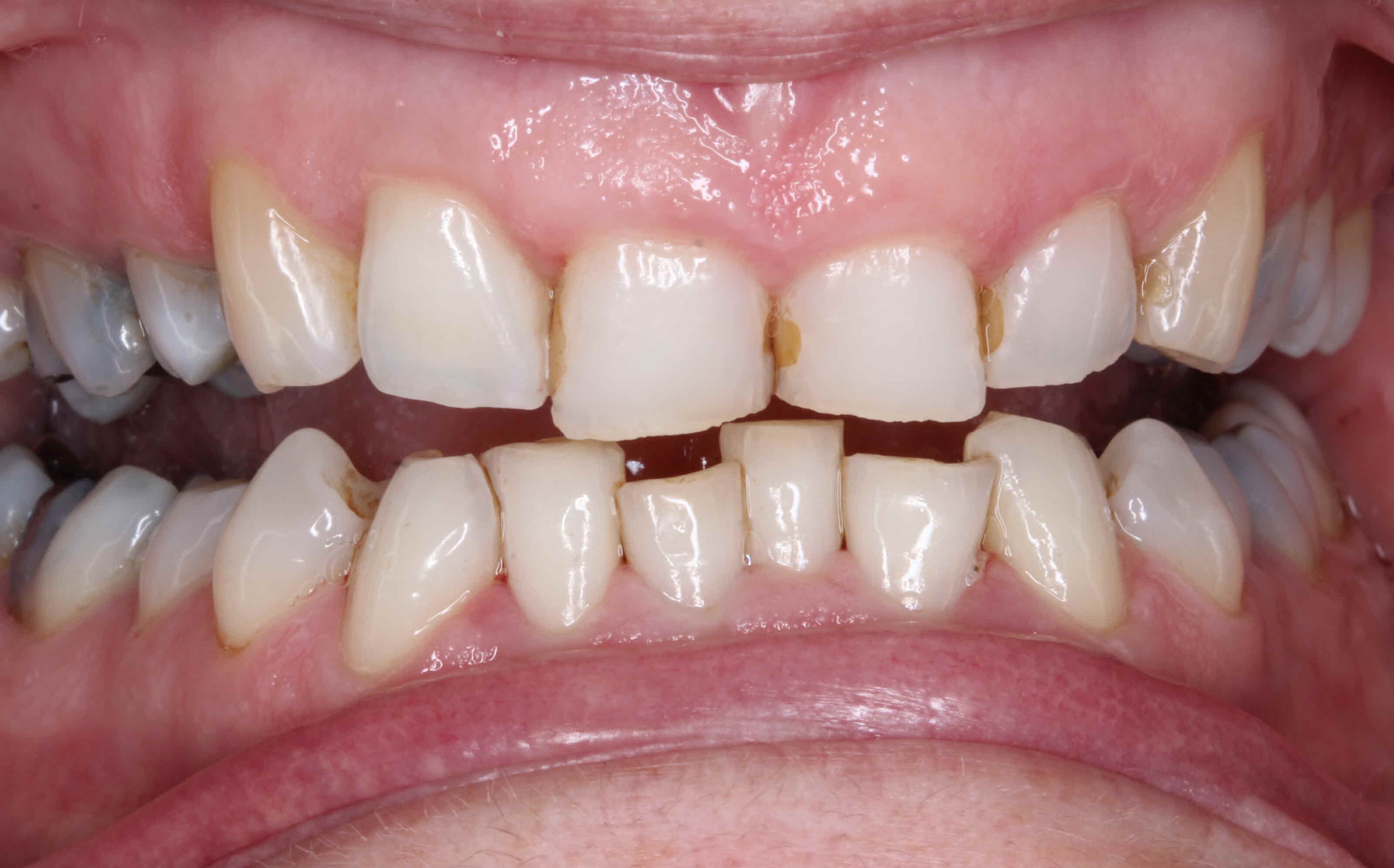 Implant 1 After