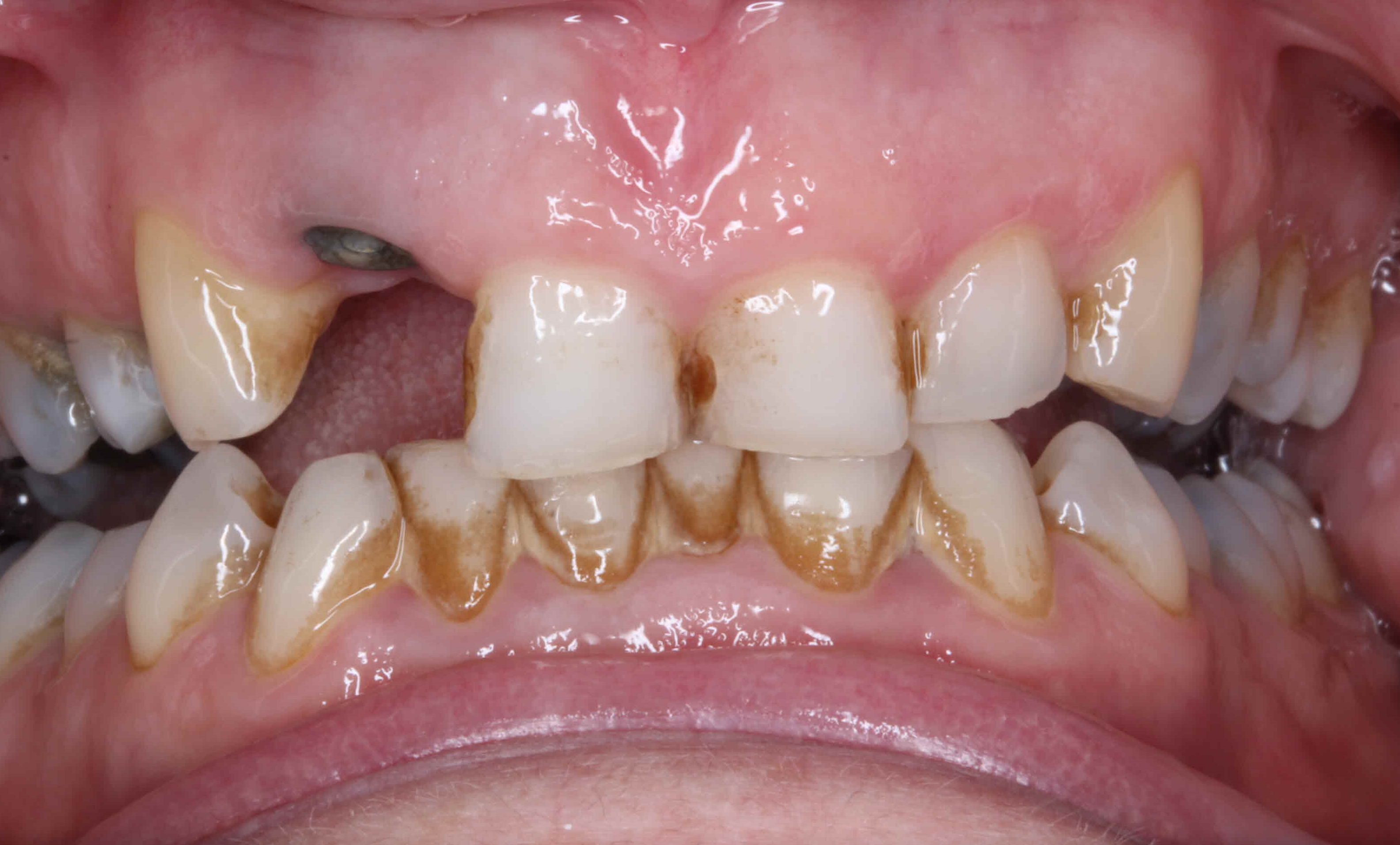 Implant 1 Before