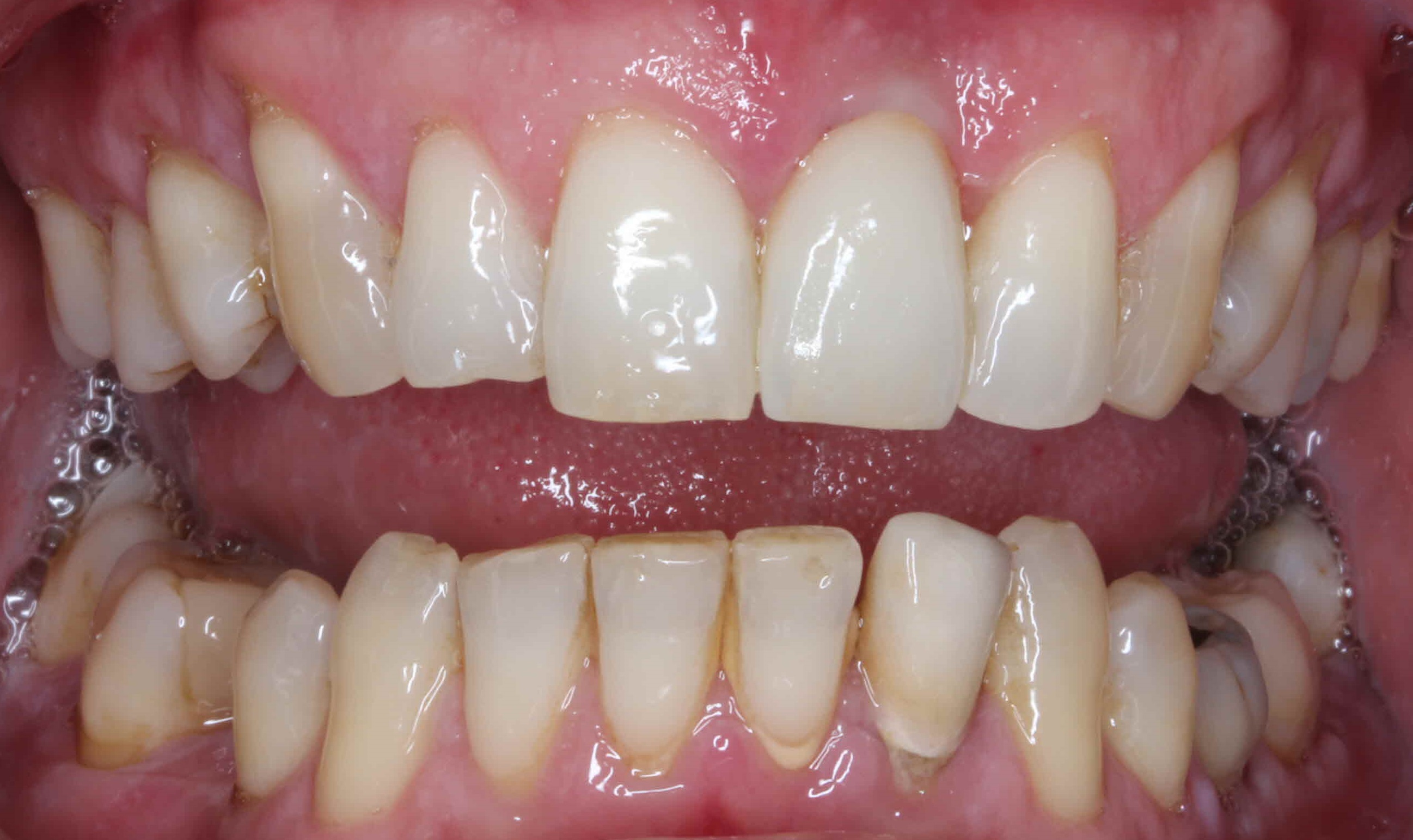 Implant 2 After