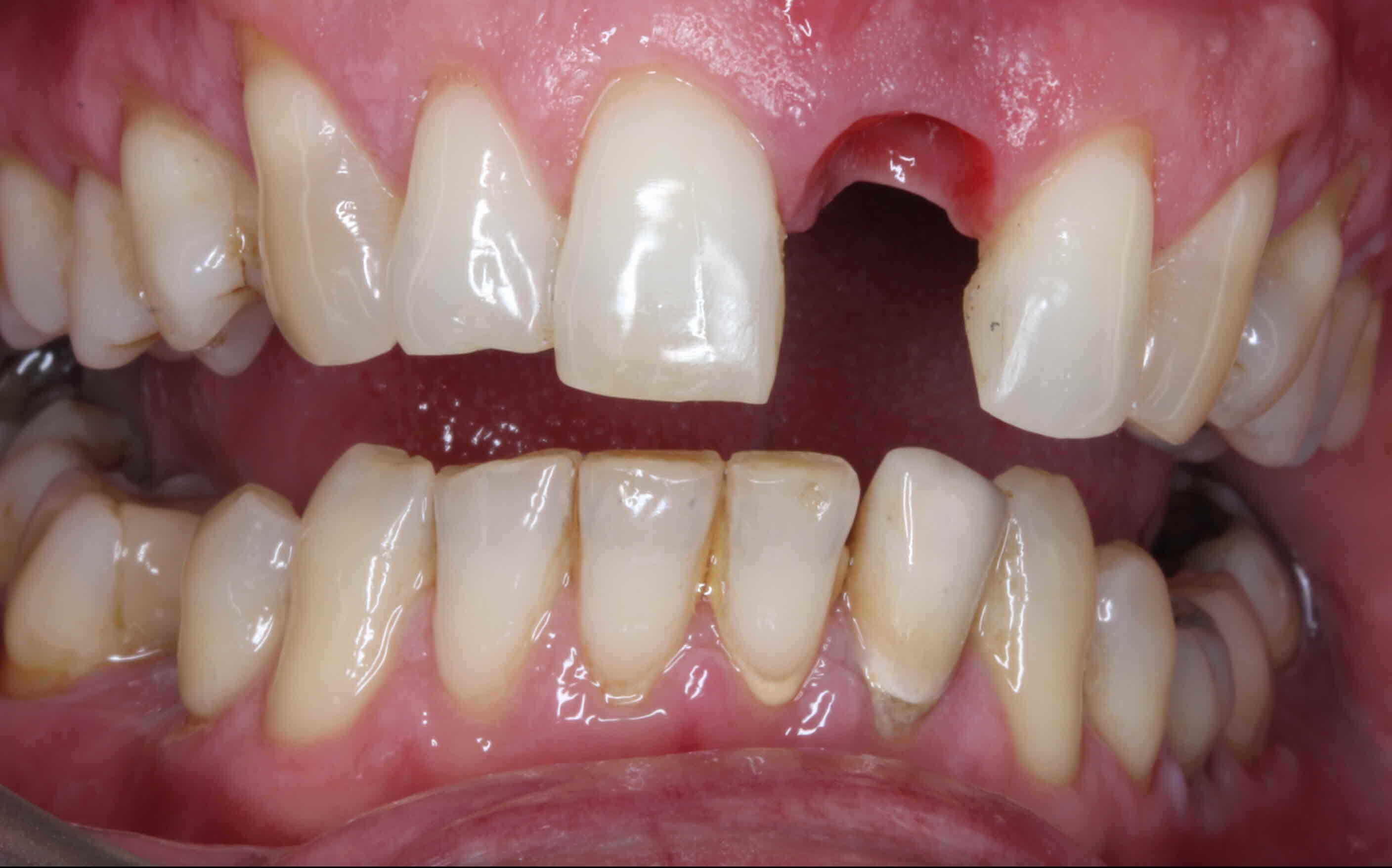 Implant 2 Before