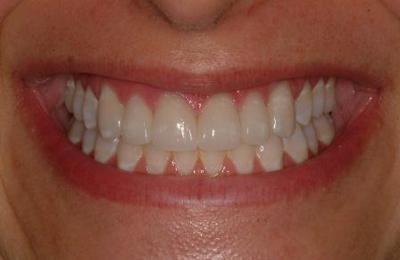 Veneers 1 After