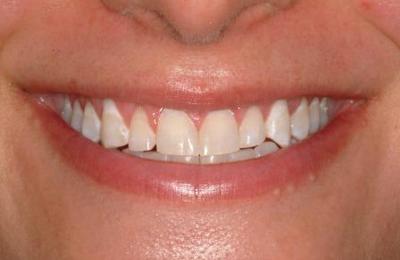 Veneers 1 Before
