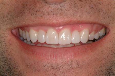 The Lifelong Cost Of The Selfie Smile Optional Dental Veneers