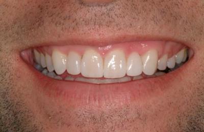 Veneers 2 After