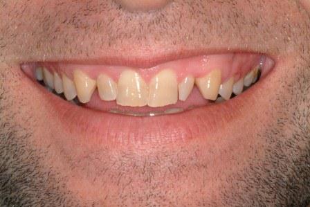 Veneers 2 Before