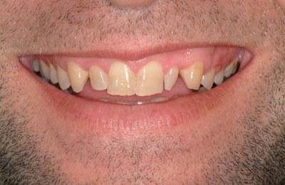 Veneers 2 Before