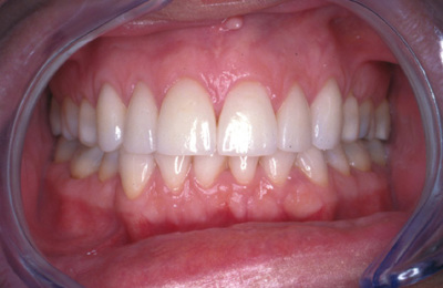 Porcelain Veneers Rob Proudmouth After
