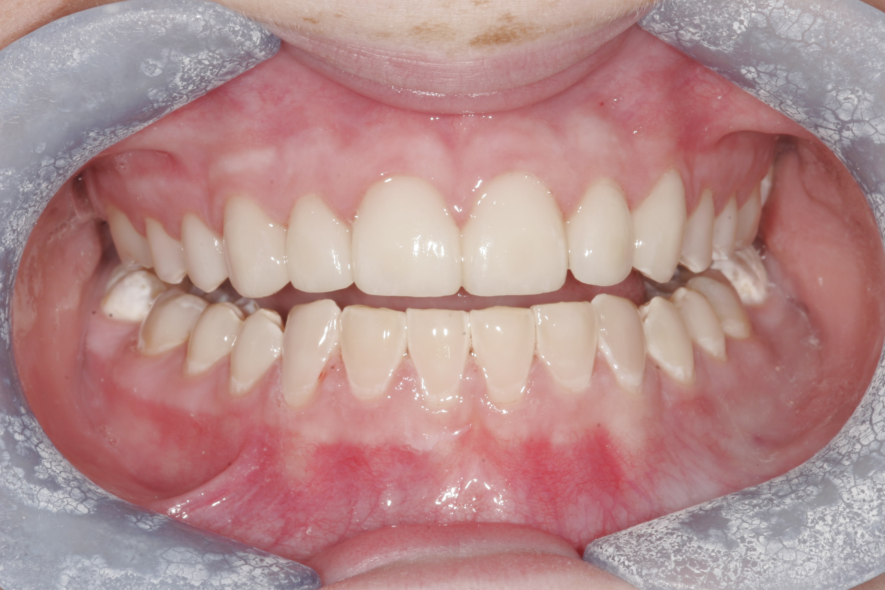 Composite And Porcelain Veeners After