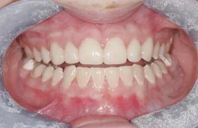 Composite And Porcelain Veeners After