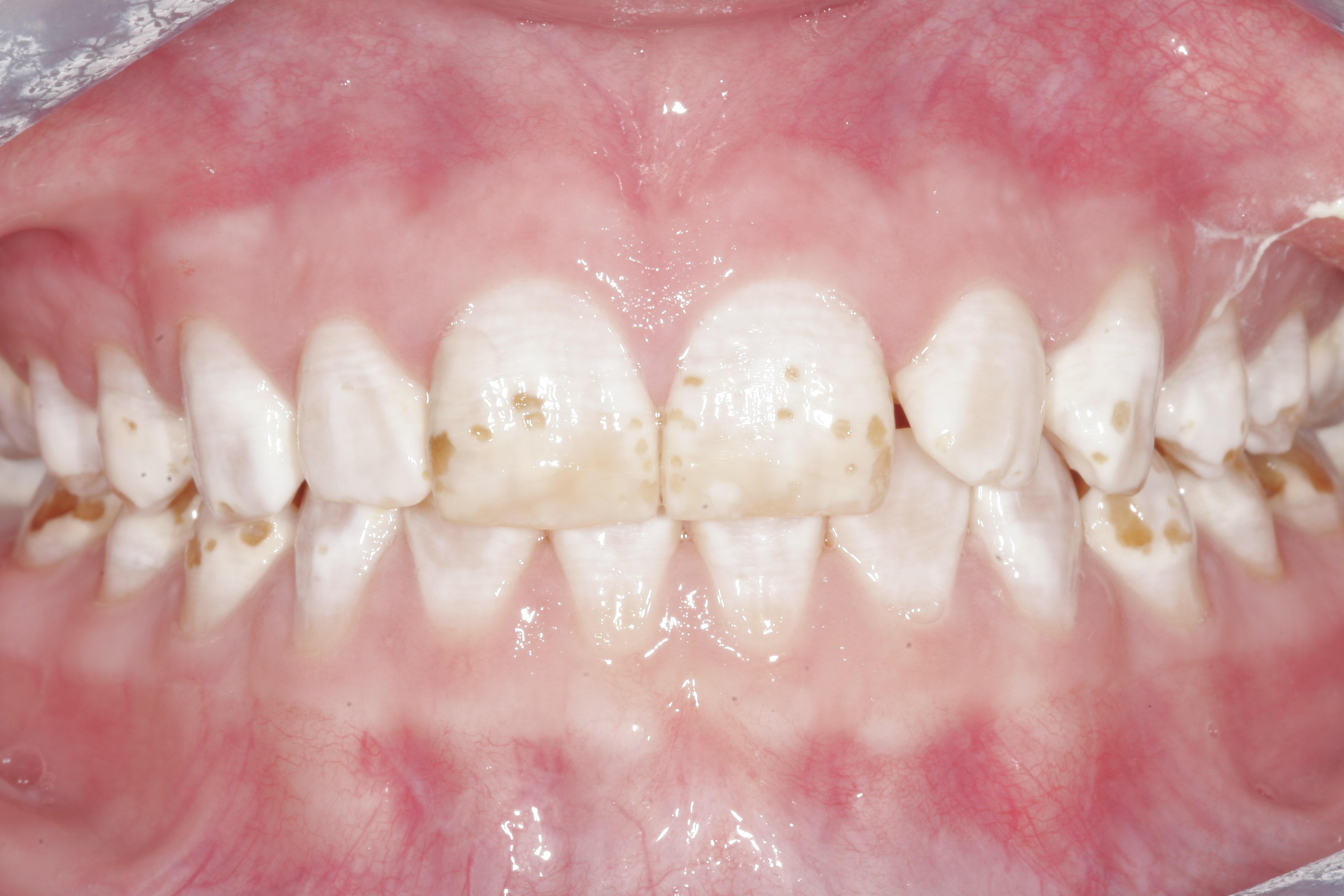 Composite And Porcelain Veeners Before