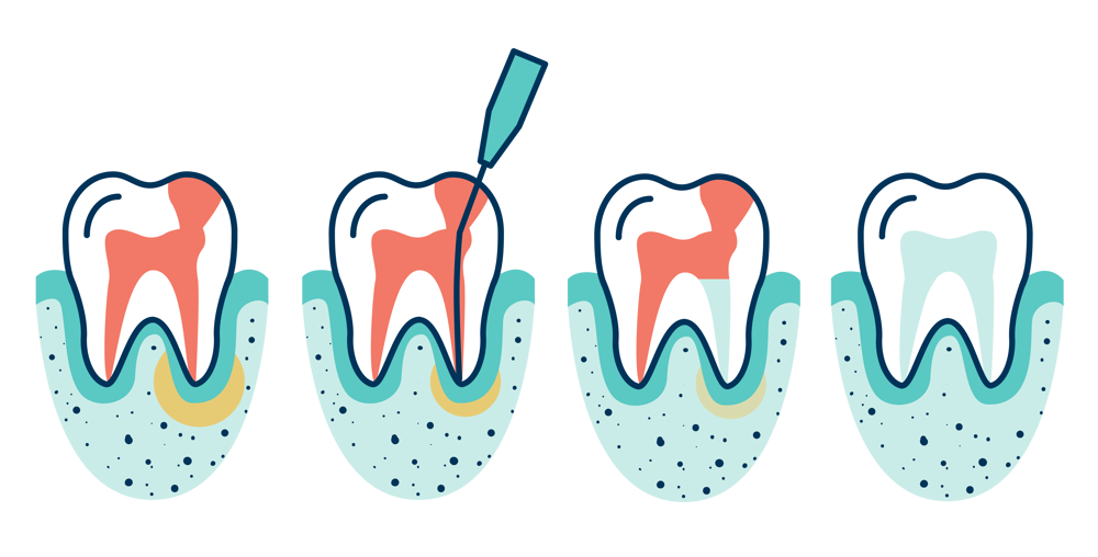 Root Canals Lumino The Dentists