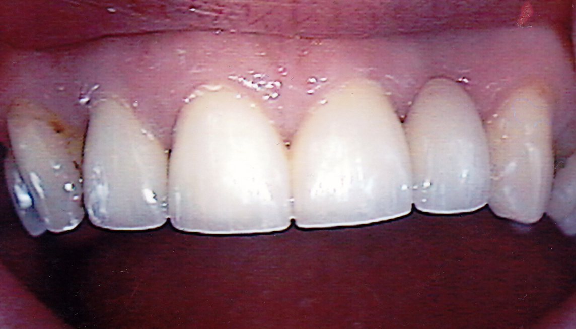 Bridge 1 After