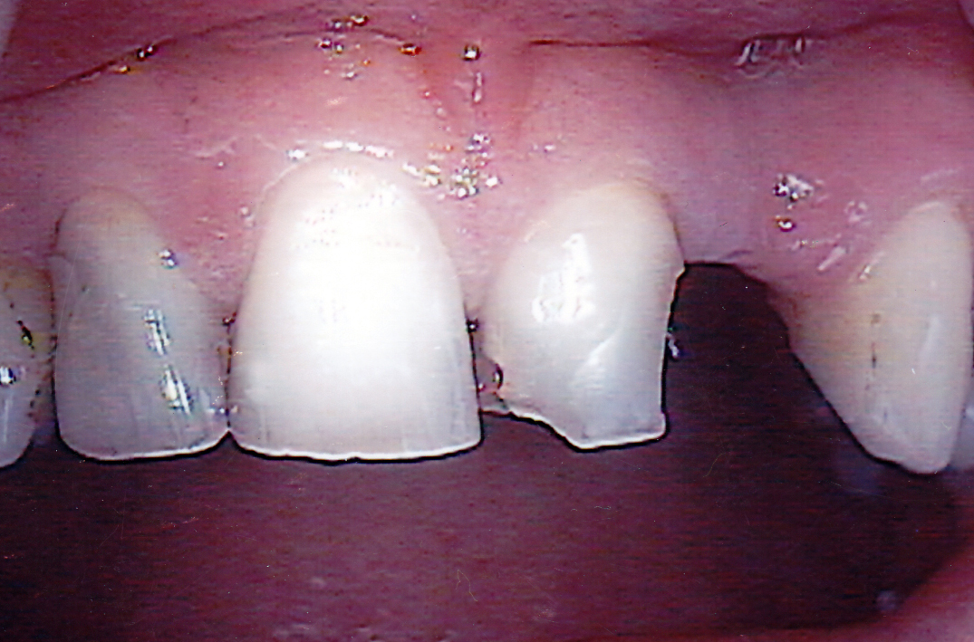 Bridge 1 Before