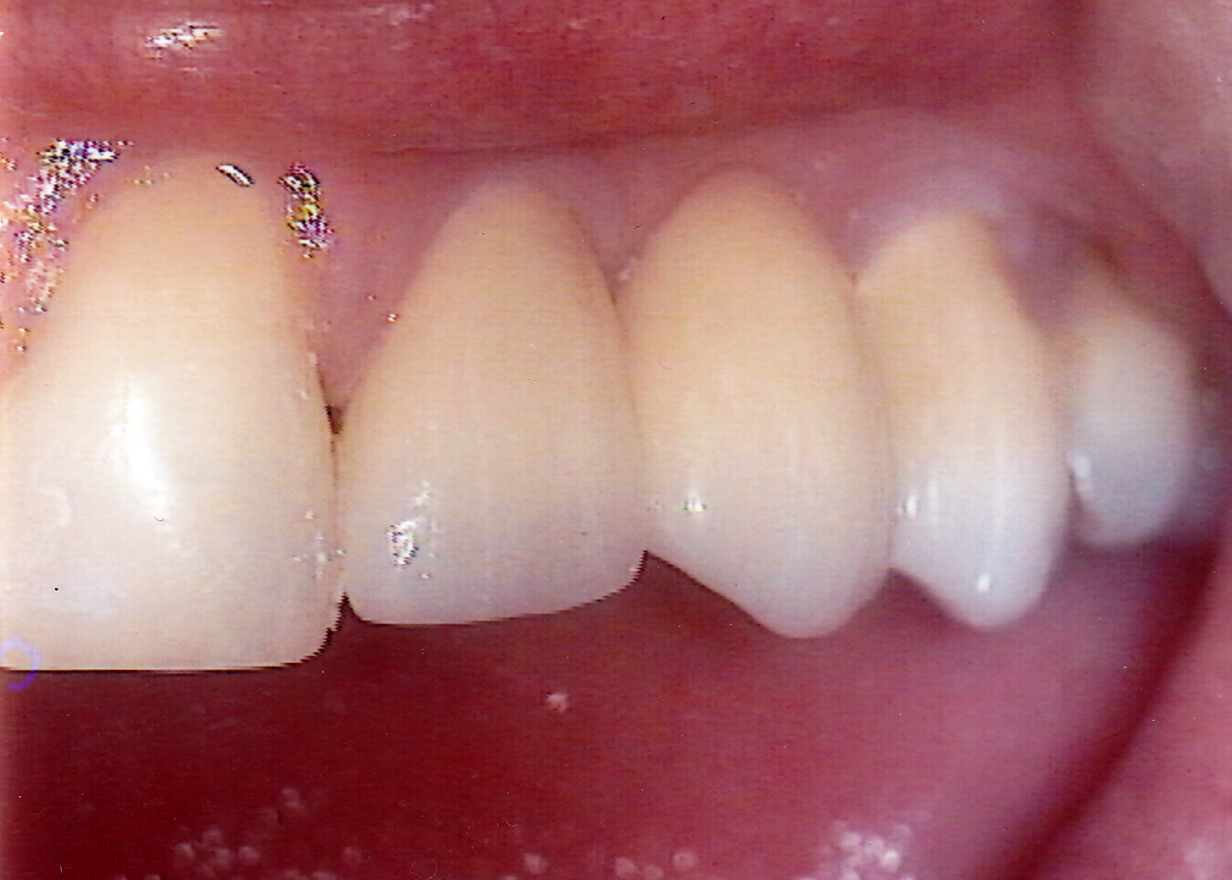 Bridge 2 After