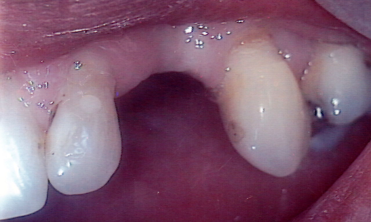 Bridge 2 Before