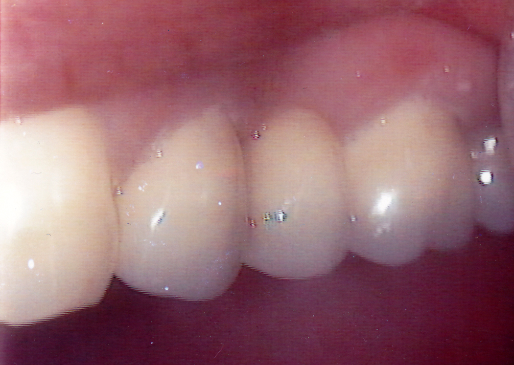 Bridge 3 After