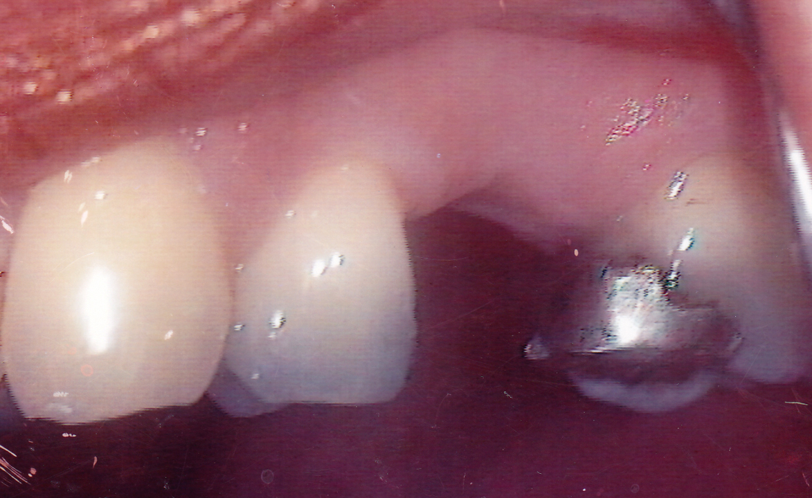 Bridge 3 Before