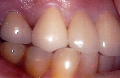 Porcelain Tooth Lengthening After