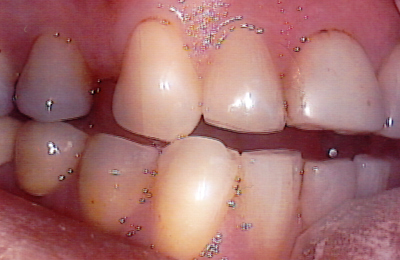 Porcelain Tooth Lengthening Before
