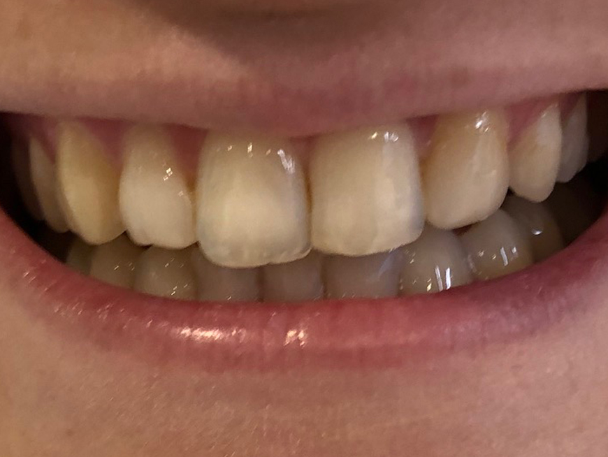Nicky Teeth Before