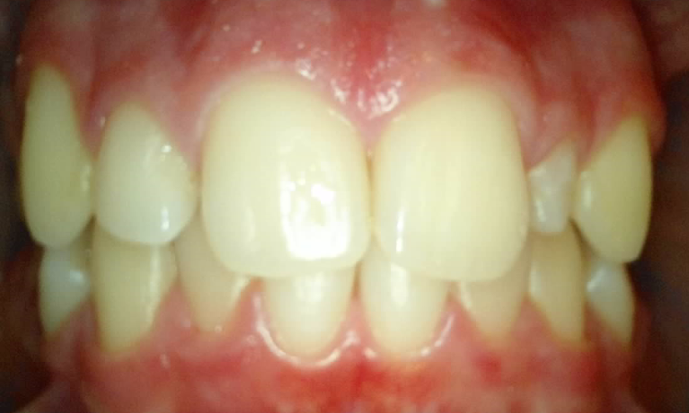 Medium Before Reshaping Peg Lateral Without Orthodontics