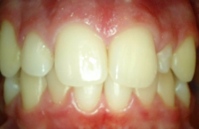 Medium Before Reshaping Peg Lateral Without Orthodontics