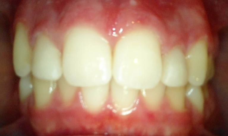Medium After Reshaping Peg Lateral Without Orthodontics