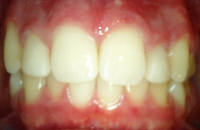 Medium After Reshaping Peg Lateral Without Orthodontics