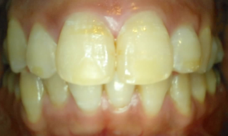 Medium Before In Chair Bleaching