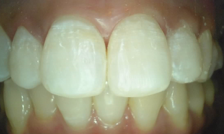 Medium After In Chair Bleaching