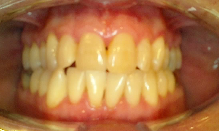 Medium Before Opalescence Boost In Chair Whitening
