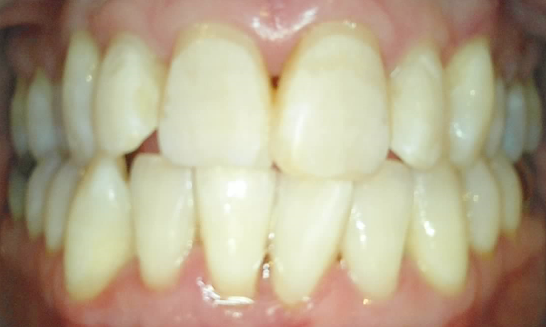 Medium After Opalescence Boost In Chair Whitening
