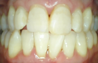 Medium After Opalescence Boost In Chair Whitening