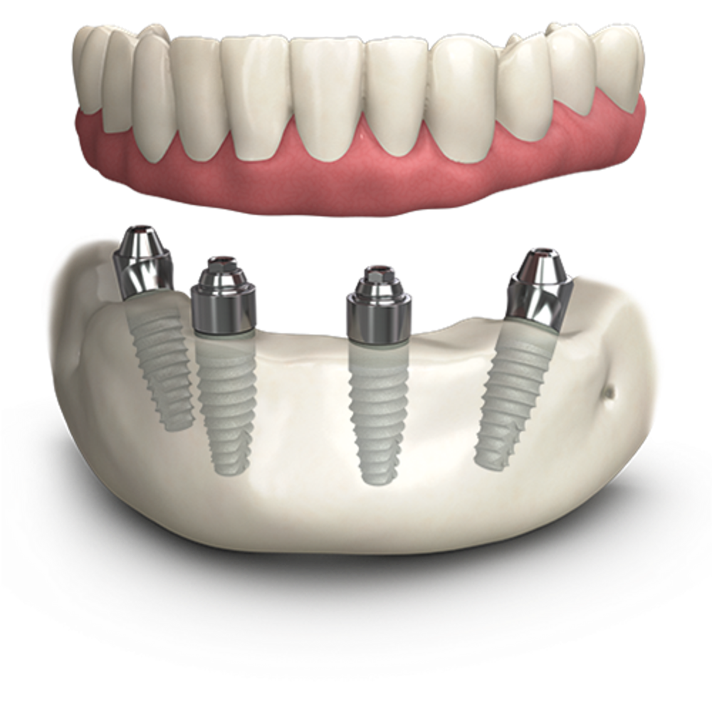 Collection 90+ Wallpaper Allon4 Dental Implants Pictures Full HD, 2k