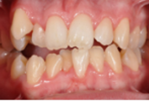 Before Crowding correction