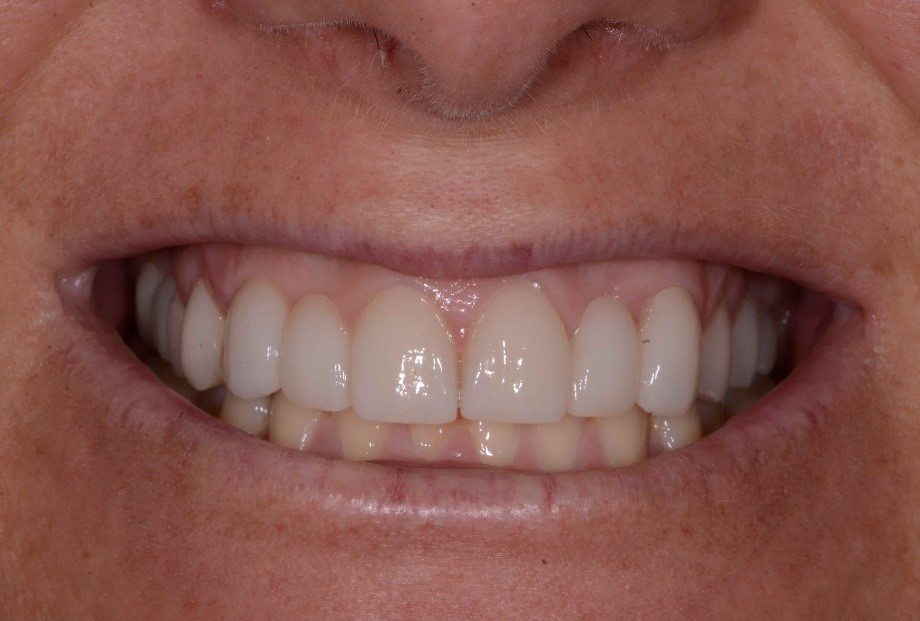 Kerikeri Implants Image 1B