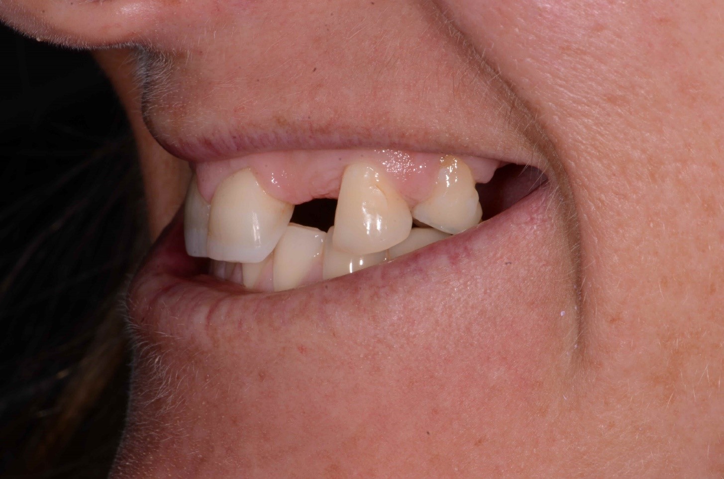 Kerikeri Implants Image 2A