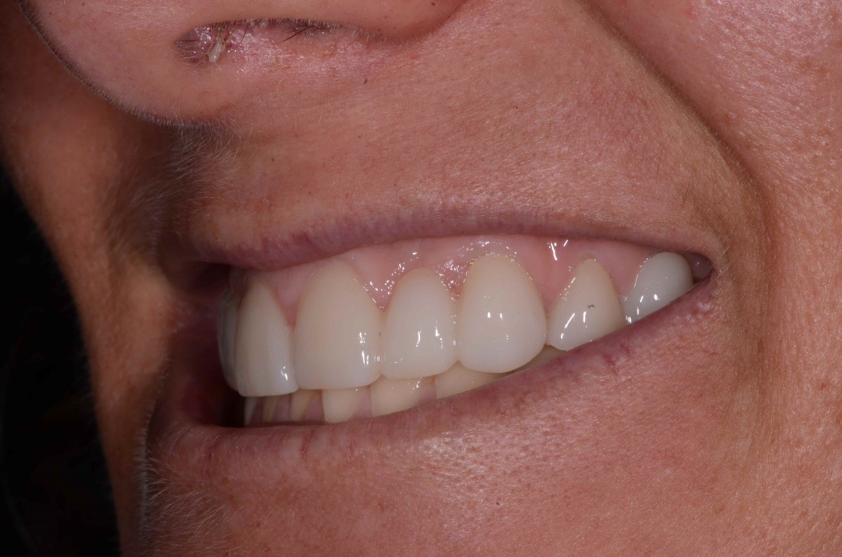 Kerikeri Implants Image 2B