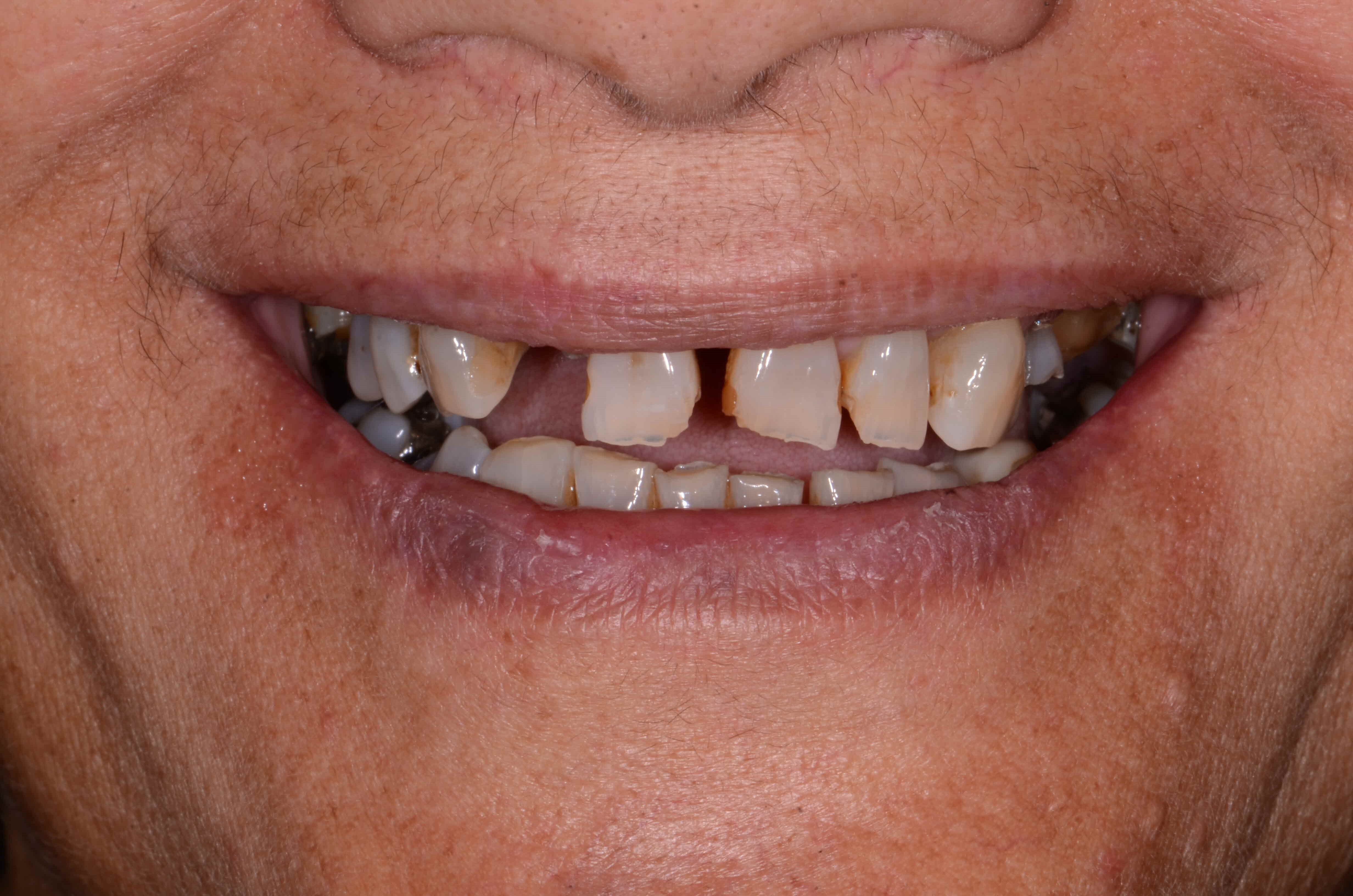 Kerikeri Implants Image 3A