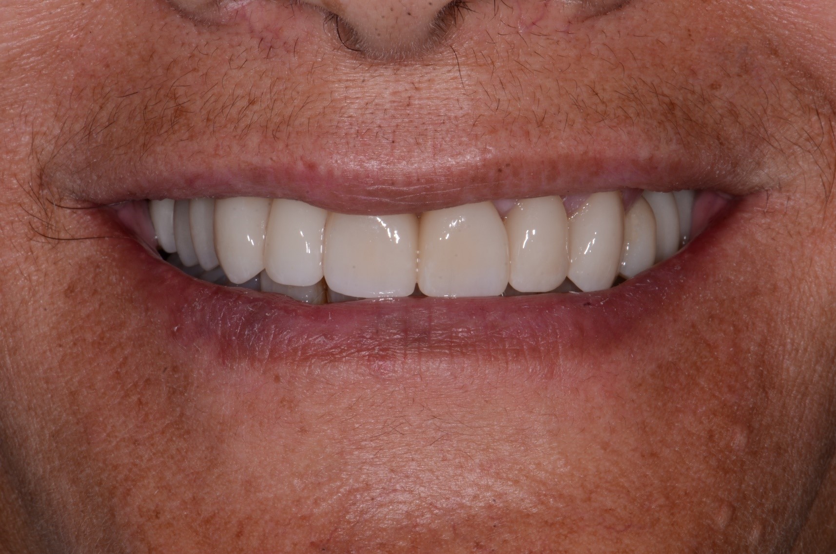Kerikeri Implants Image 3B