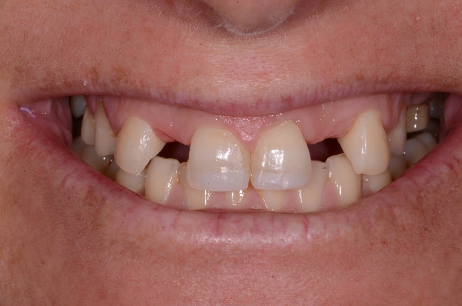 Kerikeri Implants Image 1A