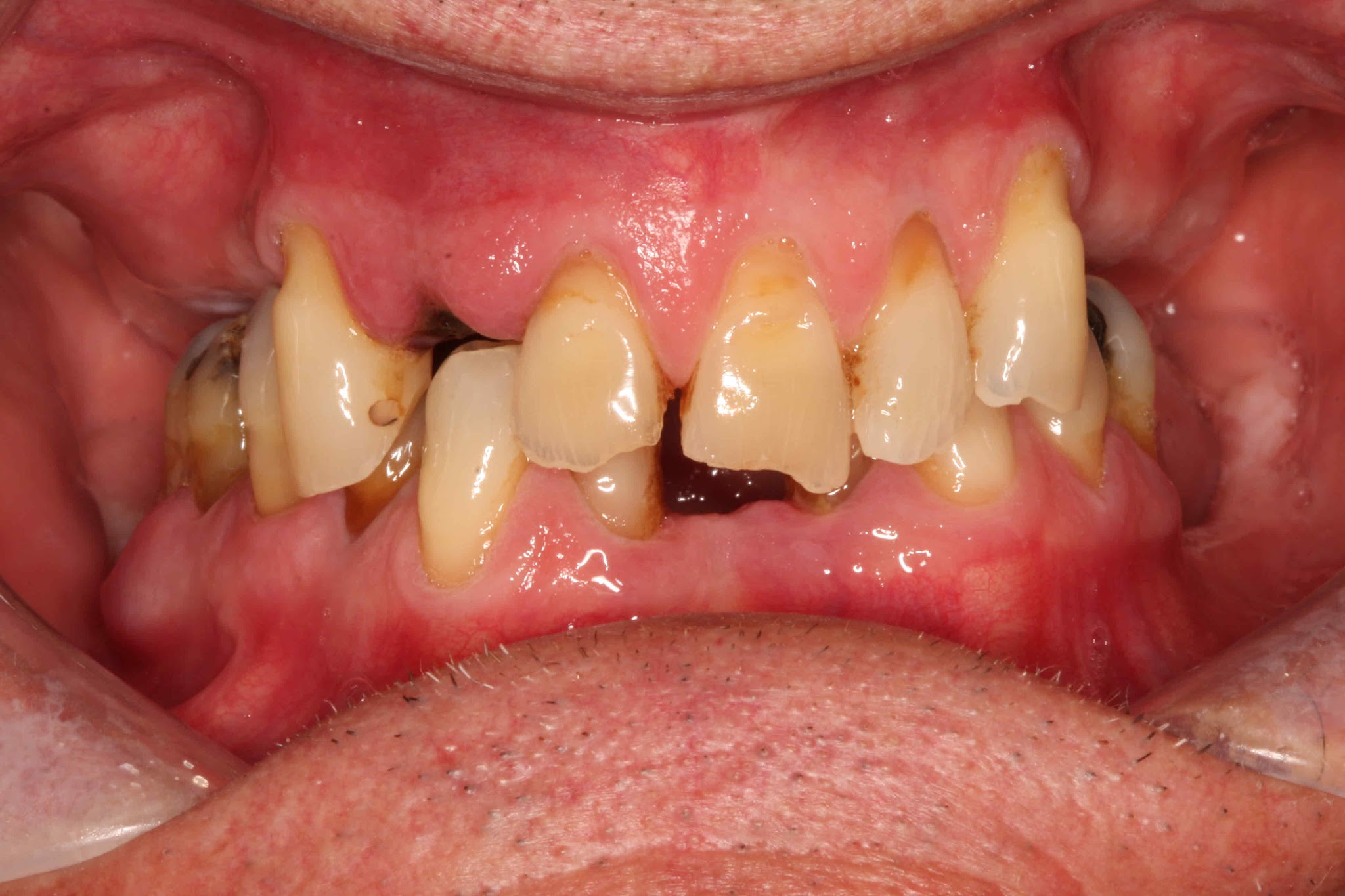 Teethxpress Before After 3A