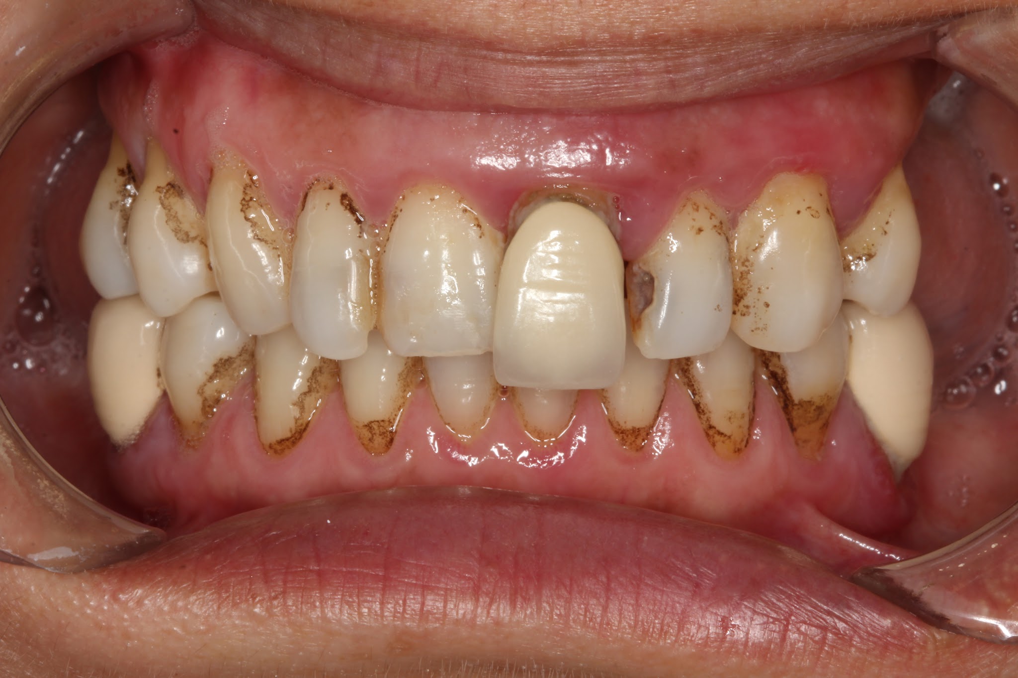 Teethxpress Before After 2A
