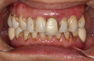 Teethxpress Before After 2A