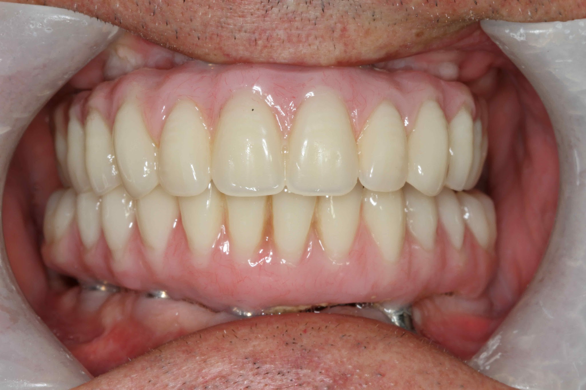 Teethxpress Before After 3B