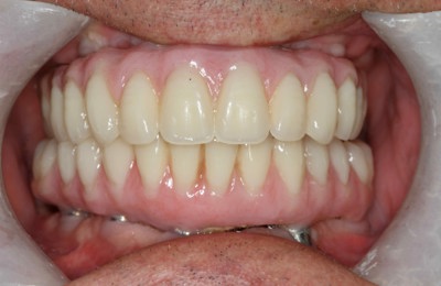 Teethxpress Before After 3B