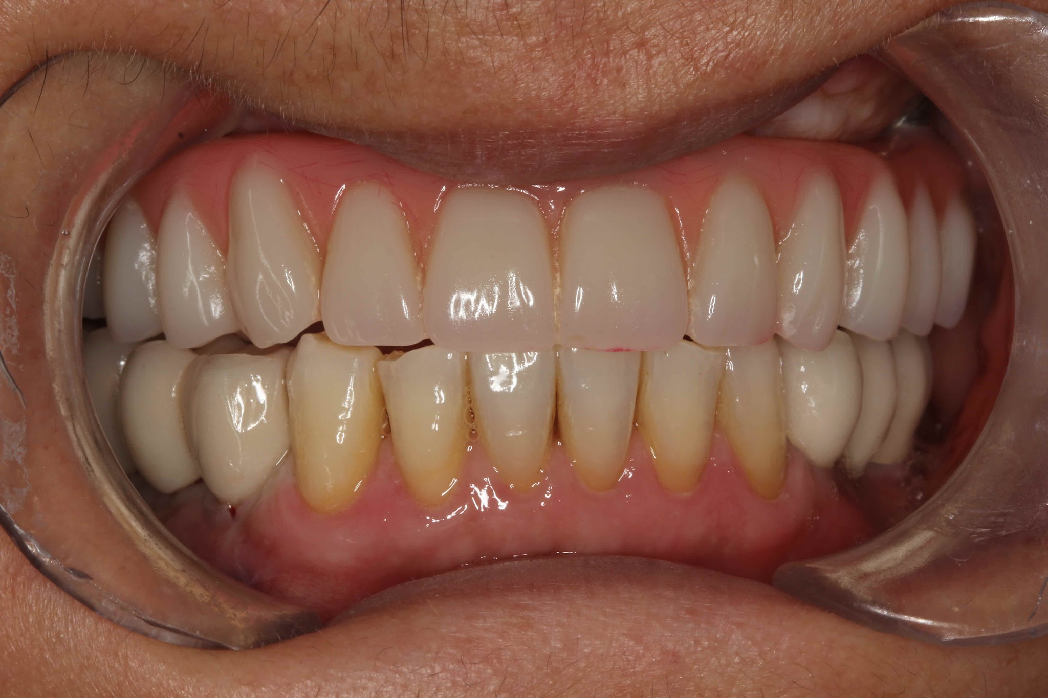 Teethxpress Before After 2B