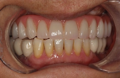 Teethxpress Before After 2B